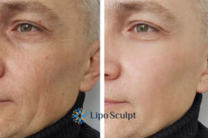 How to Fight Aging Symptoms 3 Fight Aging Symptoms Stroud With HIFU and Morpheus8 Today!
