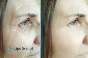 How to Fight Aging Symptoms 2 Do you want to Fight Aging Symptoms Stroud? Contact Lipo Sculpt today!