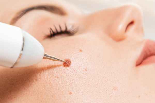 CryoPen: 5 Skin Concerns It May Be Used to Treat 3 What actually happens during a CryoPen treatment Stroud?